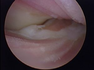 Severe elbow arthritis